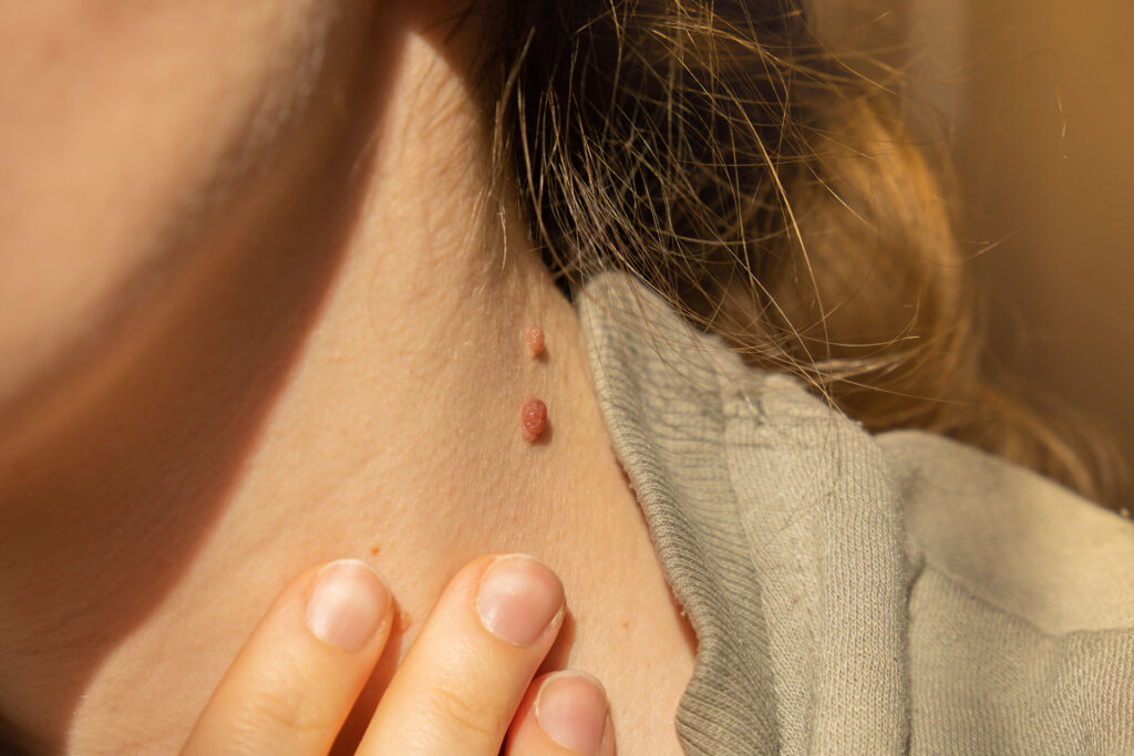 how to check for skin cancer at home