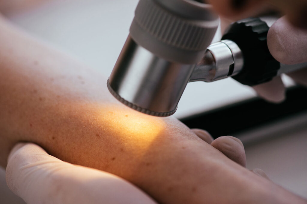 Identifying When a Mole Warrants a Skin Cancer Check 2 Skin Cancer